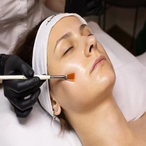 Chemical Peels for the Treatment of Melasma in Patients with Dark Skin