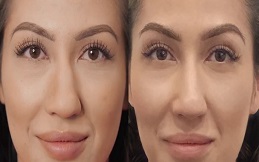 Cost of Botox for Nose before and after