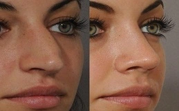 Cost of Botox for Nose before and after