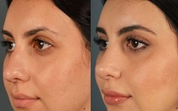 Cost of Botox for Nose before and after