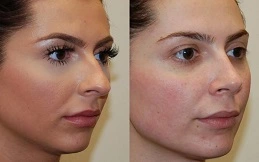 Cost of Botox for Nose before and after
