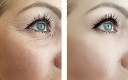 Cost of Facial Botox before and after
