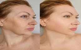 Cost of Facial Botox before and after