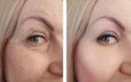 Cost of Facial Botox in before and after