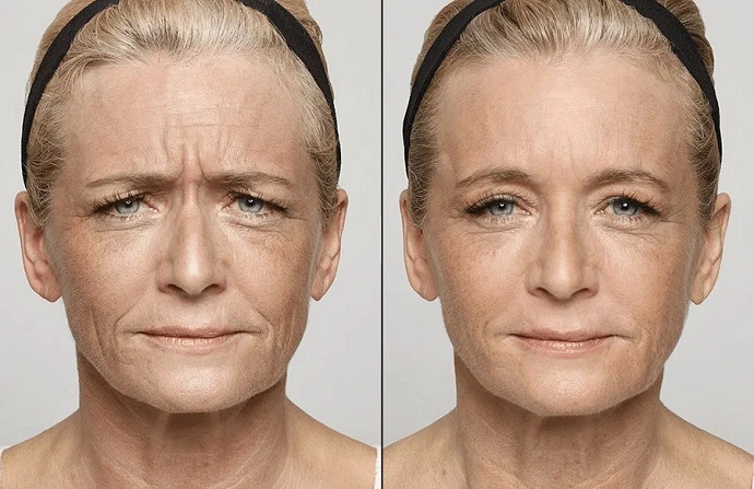 Dysport injection before and after