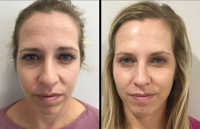 Dysport injection before and after