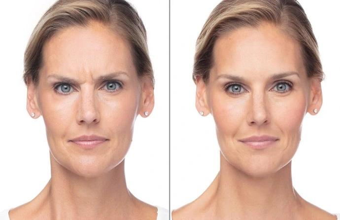 Dysport injection before and after