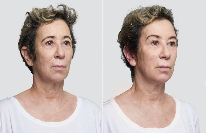 Facelift with Silhouette Threads before and after