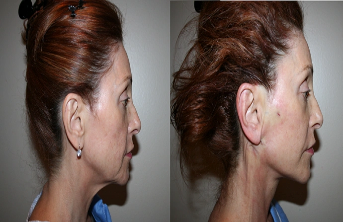 Facelift with Silhouette Threads before and after