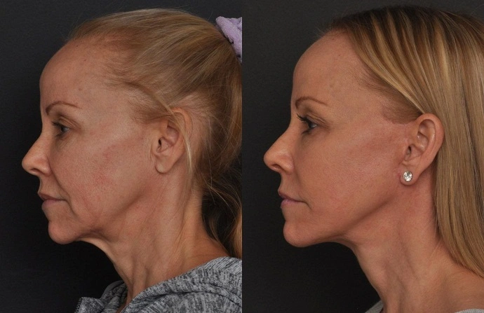 Facelift with Silhouette Threads before and after