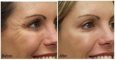 Facial Botox Injections before and after