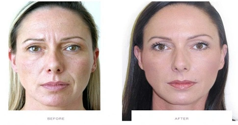 Facial Botox Injections before and after