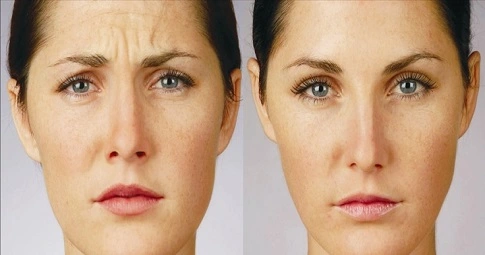 Facial Botox Injections before and after