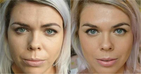 Facial Botox Injections before and after