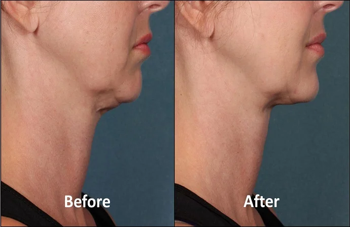 Kybella treatment for double chin before and after