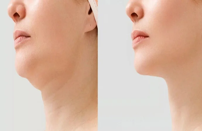 Kybella treatment for double chin before and after