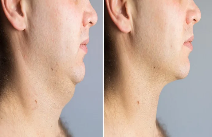 Kybella treatment for double chin before and after