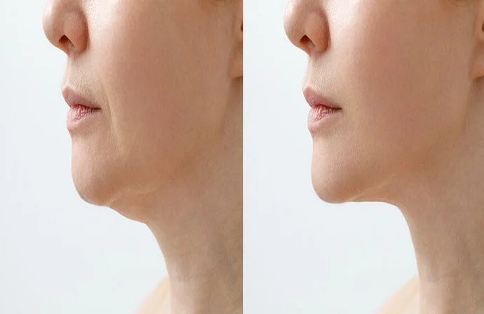 Kybella treatment for double chin before and after