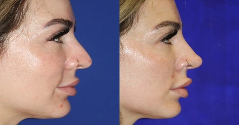 Liquid Rhinoplasty before and after