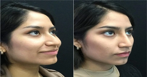 Liquid Rhinoplasty before and after