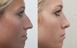 Liquid Rhinoplasty Cost in Dubai