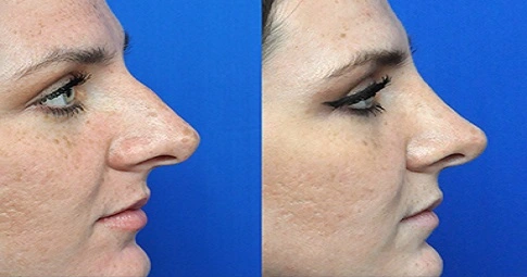 Liquid Rhinoplasty before and after