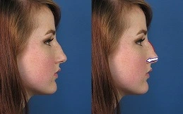 Liquid Rhinoplasty Cost in Dubai