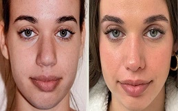 Liquid Rhinoplasty Cost in Dubai