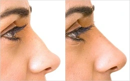 Liquid Rhinoplasty Cost in Dubai