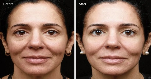 Peptide Treatment before and after