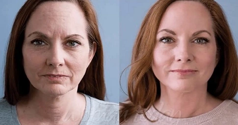 Peptide Treatment before and after