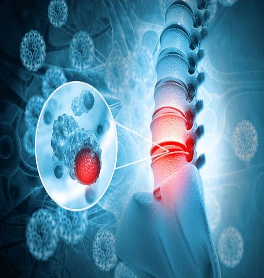 Plasma back pain treatment in Dubai