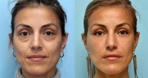 Restylane Lift before and after