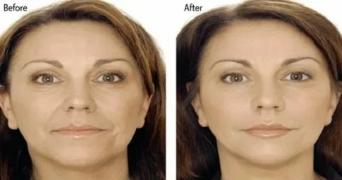 Restylane Lift before and after