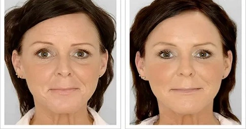 Restylane Lift before and after