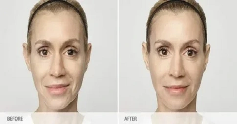 Restylane Lift before and after