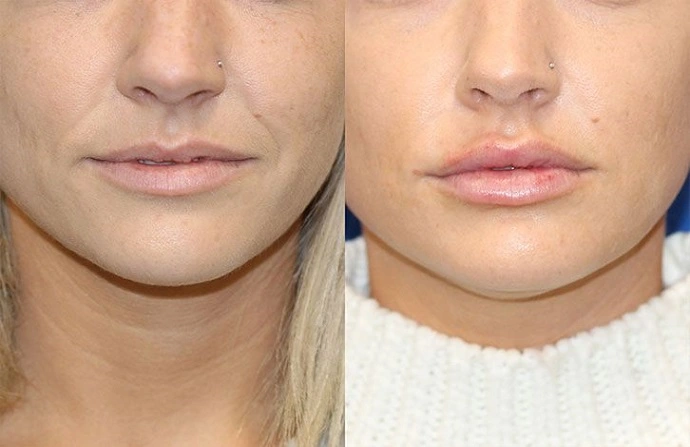 Volbella Fillers before and after