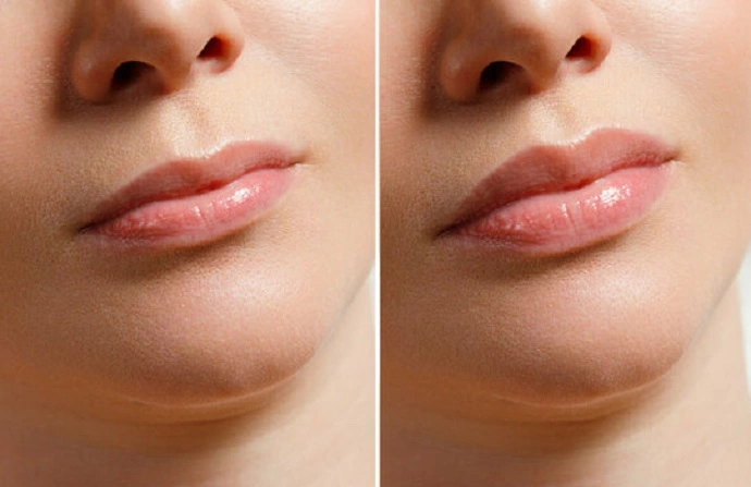 Volbella Fillers before and after
