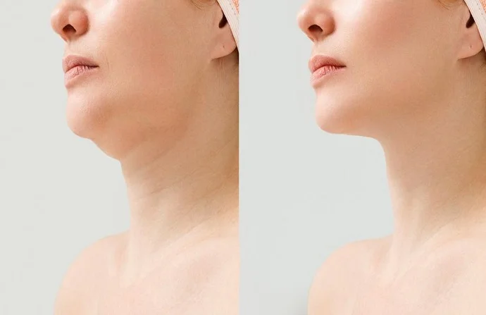 Belkyra Treatment before and after