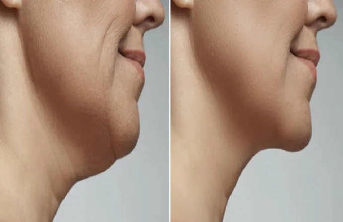 Belkyra Treatment before and after