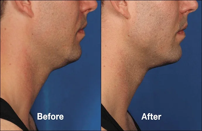 Belkyra Treatment before and after