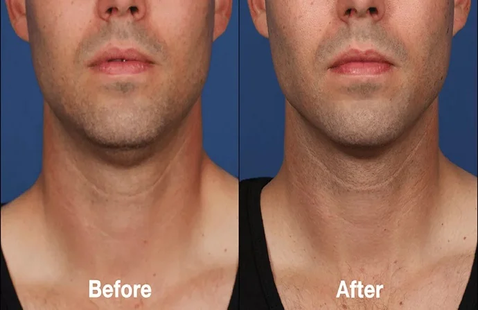 Belkyra Treatment before and after