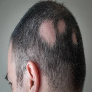 Cost of Alopecia Areata Treatment in the UAE