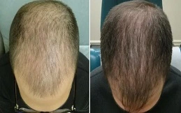 Cost of G-Cell Treatment before and after