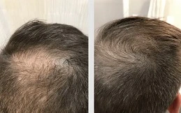 Cost of G-Cell Treatment before and after