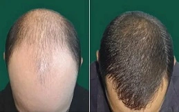 Cost of G-Cell Treatment before and after