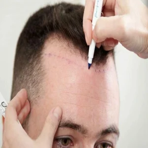 The Cost of Hair Transplantation Using the FUT Technique in Dubai