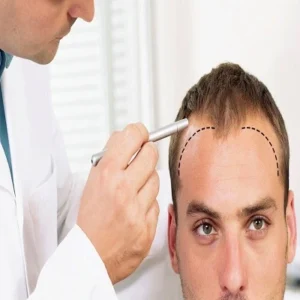 How Much Does Hair Transplantation Cost In The UAE?