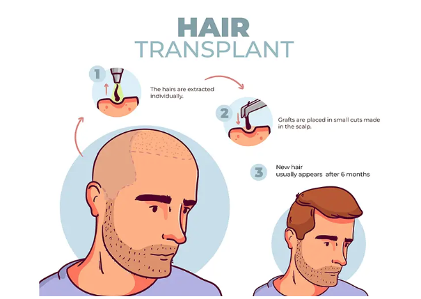 How Hair Transplant is Done