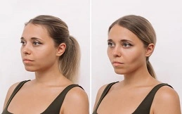 Jaw Surgery Cost before and after